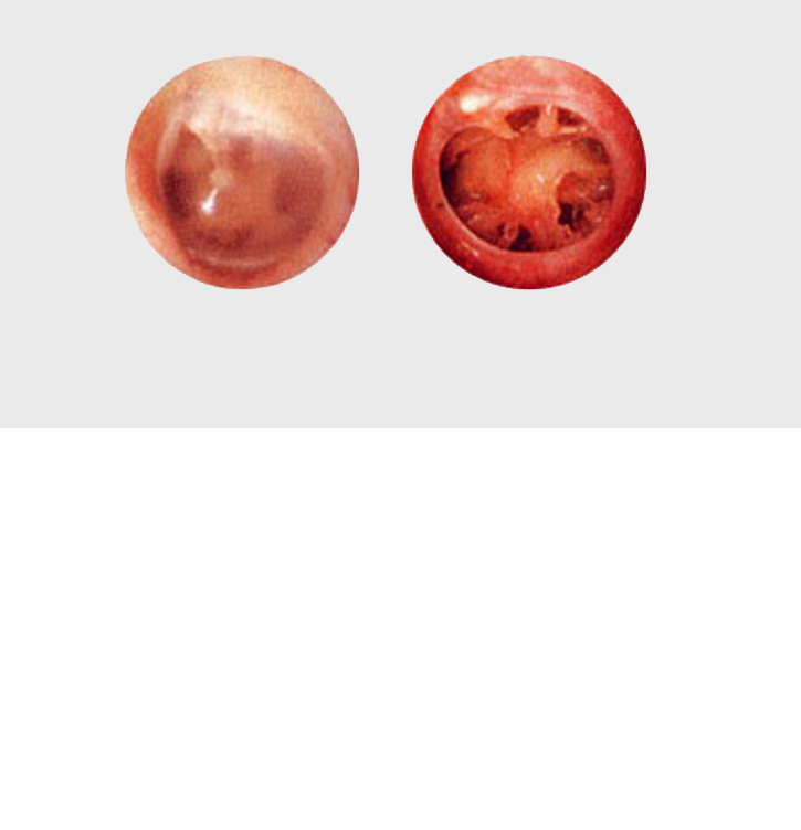 정상고막과 만성중이염(고막에 구멍 있음) 고막 사진